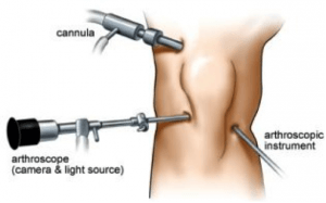 arthroscopic procedure knee scope